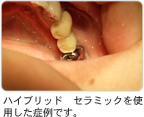 ハイブリッド セラミックを使用した症例です。