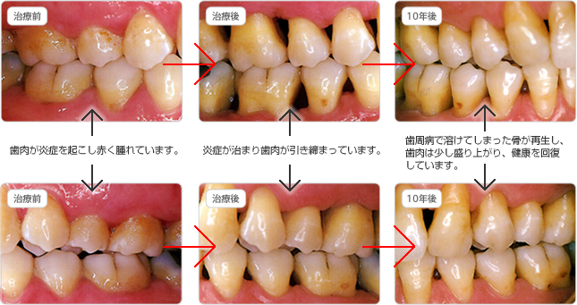 歯 周 病 治っ た 人
